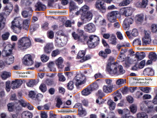 Şekil 10. Germinal merkez hücreleri (büyük büyütme): Sentroblastlar, küçük ya da büyük sentrositler, içlerinde boyanabilen apoptotik B lenfosit kalıntıları bulunan tingible body makrofajlar ve soluk boyanan dendritik hücreler.