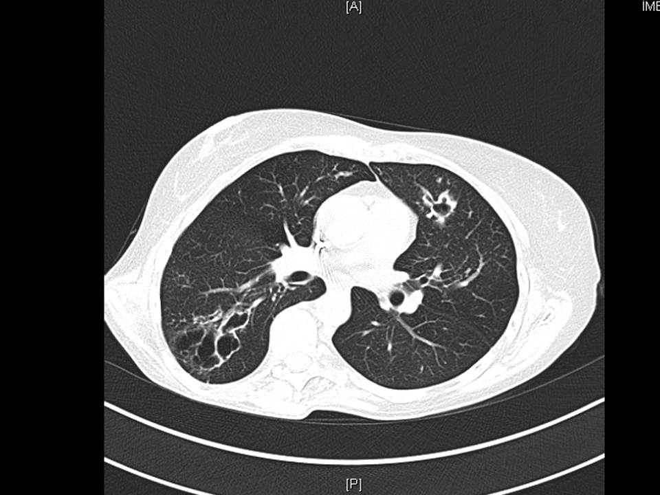 Akciğer tomografisi
