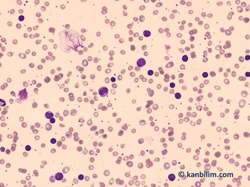 KLL-hemolitik anemi